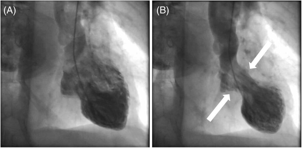 broken heart syndrome