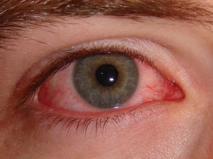 Conjunctivitis