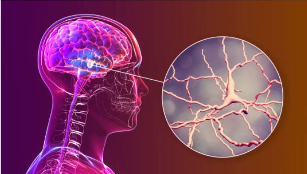 : Researchers at the University of Alabama at Birmingham (UAB) have made a significant breakthrough in treating Parkinson’s disease by targeting the Activin A protein.