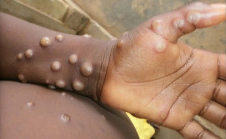 At least 25 cases of a dangerous new strain of mpox spreading through the Democratic Republic of Congo have been detected in the eastern city of Goma, mostly in camps housing people fleeing a surrounding conflict, health authorities said on Wednesday.