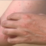 Two new mpox cases reported in Lahore