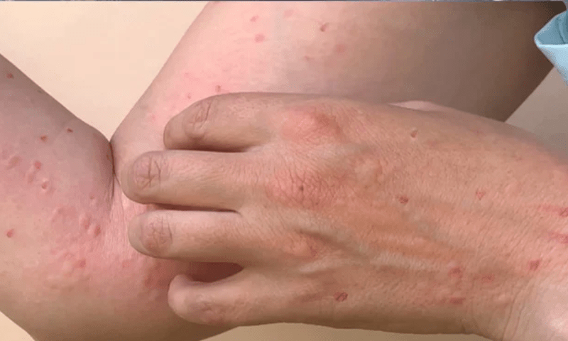 mpox patients Pakistan