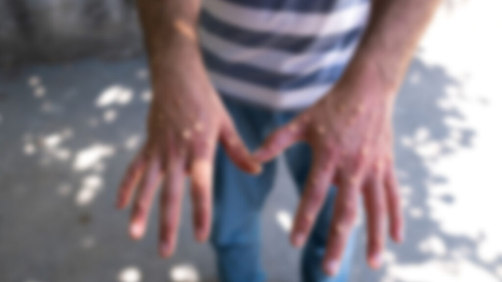 Monkey pox in Pakistan