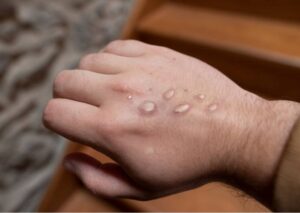 Mpox outbreak in Pakistan: Fifth case detected