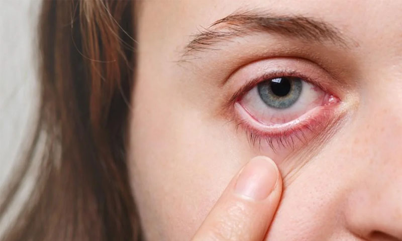 Conjunctivitis is the most common eye infection