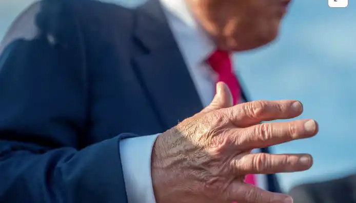 Trump diagnosed with vein condition