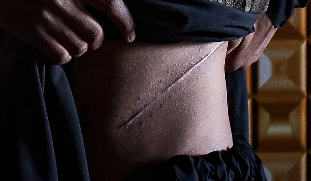 forced kidney removal