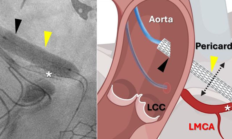 First coronary bypass surgery performed without opening chest