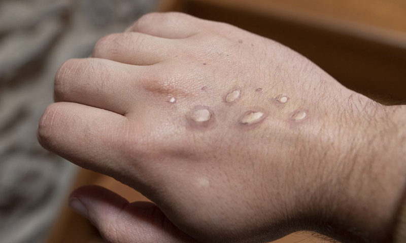 Faisalabad reports rise in suspected monkeypox cases