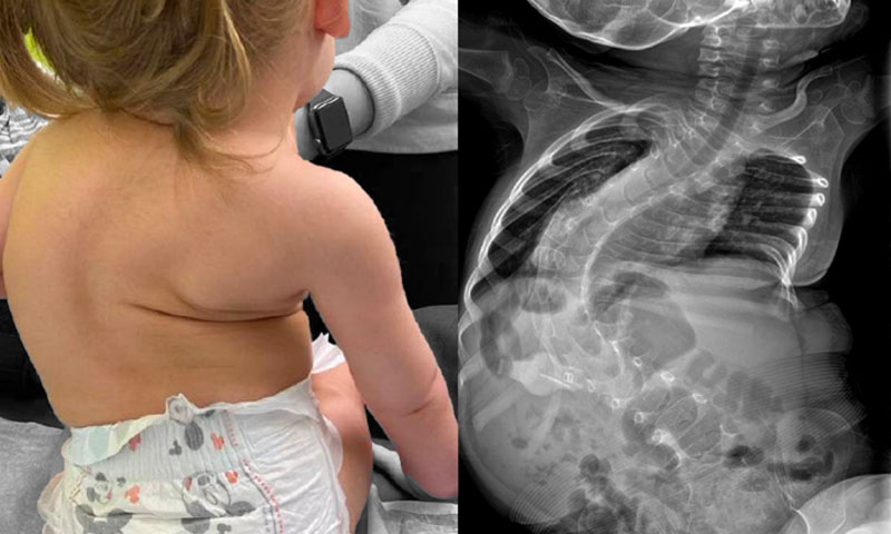 Health experts urge policy reform, sustained support for SMA patients