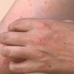 Mpox resurfaces in Karachi with second confirmed case