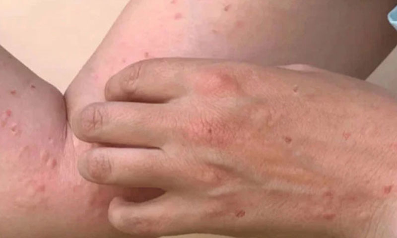 Mpox resurfaces in Karachi with second confirmed case