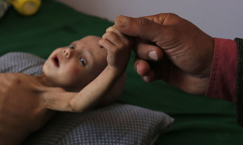 یمن: 85 ہزار بچے بھوک اور بیماری سے زندگی کی بازی ہار گئے