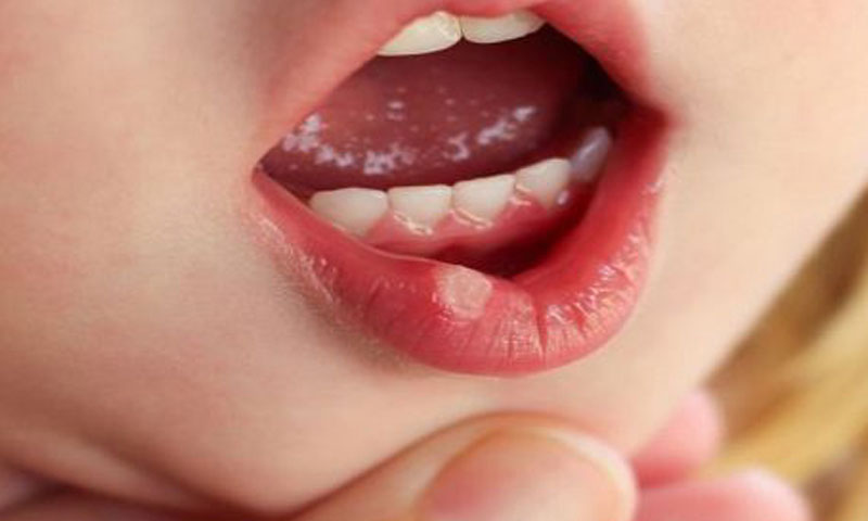 منہ کے چھالوں سے فوری نجات حاصل کریں