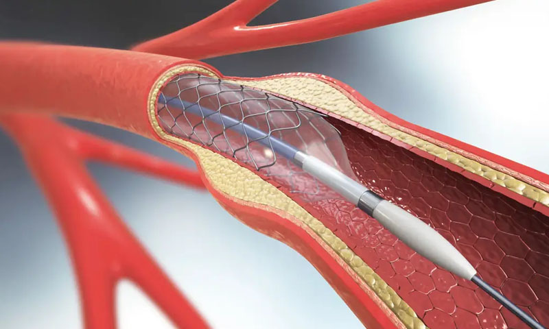 پاکستان: ہارٹ اسٹنٹ بنانے والا دوسرا اسلامی ملک بن گیا