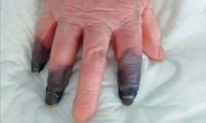کورونا سے متاثرہ خاتون تین انگلیوں سے محروم کورونا سے متاثرہ خاتون تین انگلیوں سے محروم