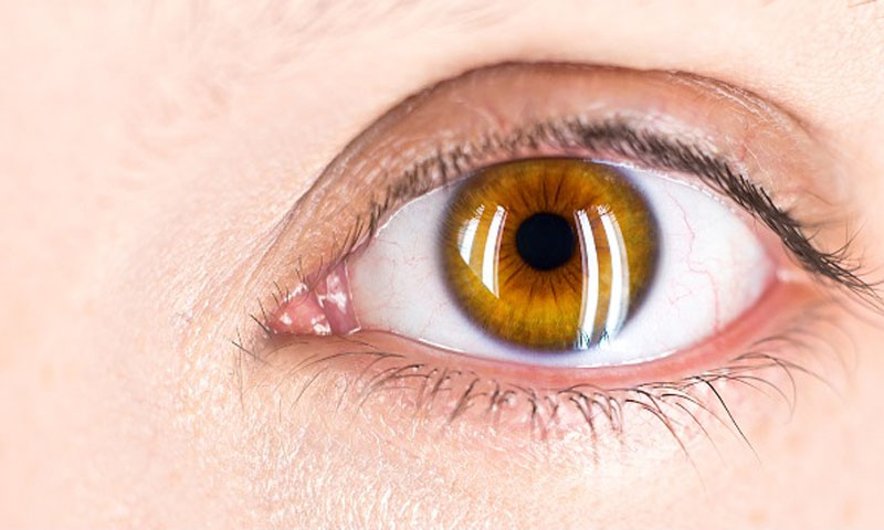 کالا موتیا: دنیا میں ہر سال کتنے لاکھ افراد اندھے ہوجاتے ہیں؟