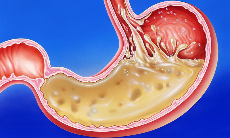 معدے میں تیزابیت اور اس سے چھٹکارے کا آسان حل