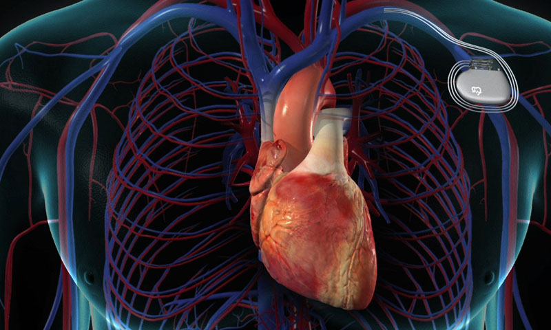 دل کے مریضوں کیلئے آچھی خبر، جسم میں جذب ہونے والا پیس میکر تیار