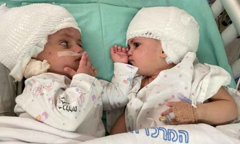 اسرائیل میں نایاب سرجری