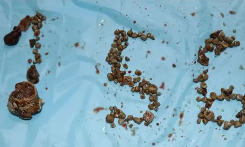 مریض کے گردے سے 156 پتھریاں برآمد