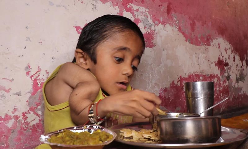 شیشے کا لڑکا: جسم کی 100 ہڈیاں تڑوا چکا