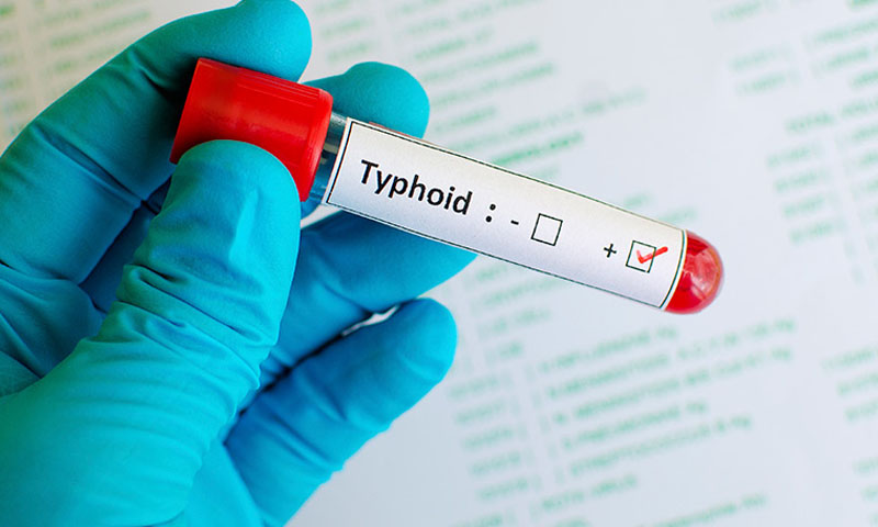 ہوشیار، کراچی کے بعد اسلام آباد میں ایکس ڈی آر ٹائیفائیڈ کیسز کی تعداد بڑھنے لگی