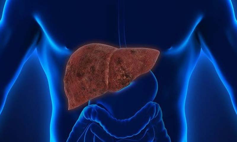 جگر fatty liver