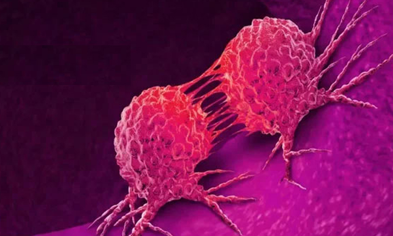 پاکستان میں طبی انقلاب، صرف 60 منٹ میں کینسر کا مکمل خاتمہ ہو گا