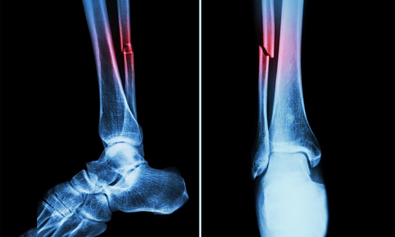 طبی دنیا میں انقلاب، منٹوں میں فریکچر جوڑنے والا سپر گلو تیار طبی دنیا میں انقلاب، منٹوں میں فریکچر جوڑنے والا سپر گلو تیار