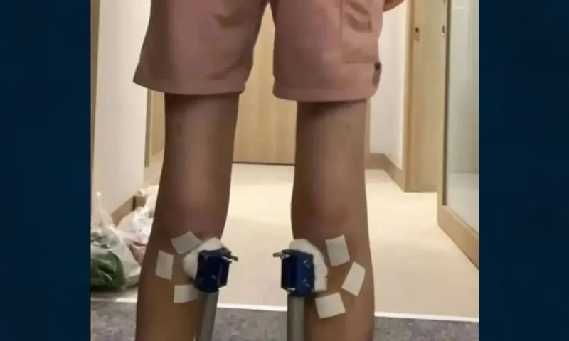 چھ ماہ کی گروتھ تھراپی، دو ہفتوں میں واپس سکڑ گیا