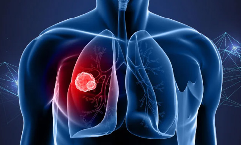 پھیپھڑوں کے کینسر کی ابتدائی علامات پیروں میں ظاہر، ماہرین