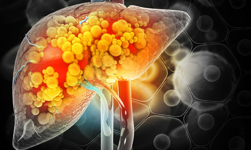 جگر کی چربی کم کرنے کے آسان اور مؤثر طریقے