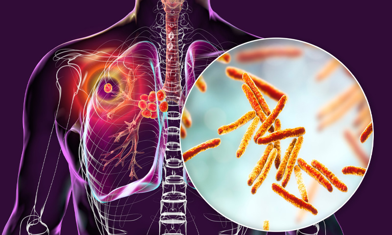 ٹی بی سے متاثرہ ممالک کی فہرست جاری؛ پاکستان کس نمبر پر؟