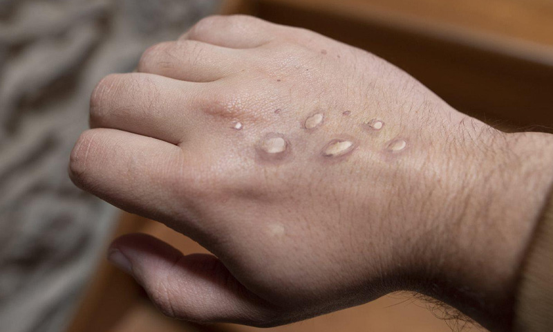 منکی پاکس کے نئے کیسز رپورٹ