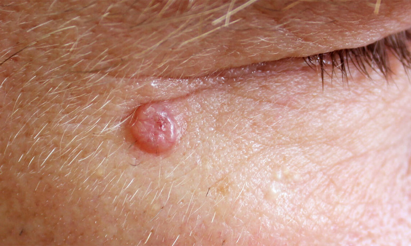 Basal Cell Carcinoma