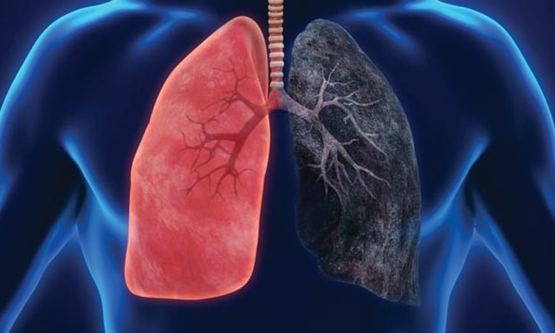 پھیپھڑوں کے کینسر کی ابتدائی علامات پیروں میں بھی ظاہر ہو سکتی ہیں، ماہرین کی وارننگ