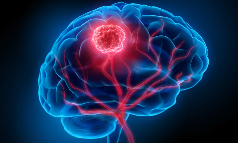 دماغی ٹیومر کی بروقت شناخت اور ابتدائی علامات، ماہرین کی ہدایات